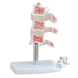 Cutaway Osteoporosis - Laboratorydeal